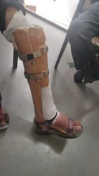 PTB Fracture Brace – Orthopedic Braces – Singar Rehab